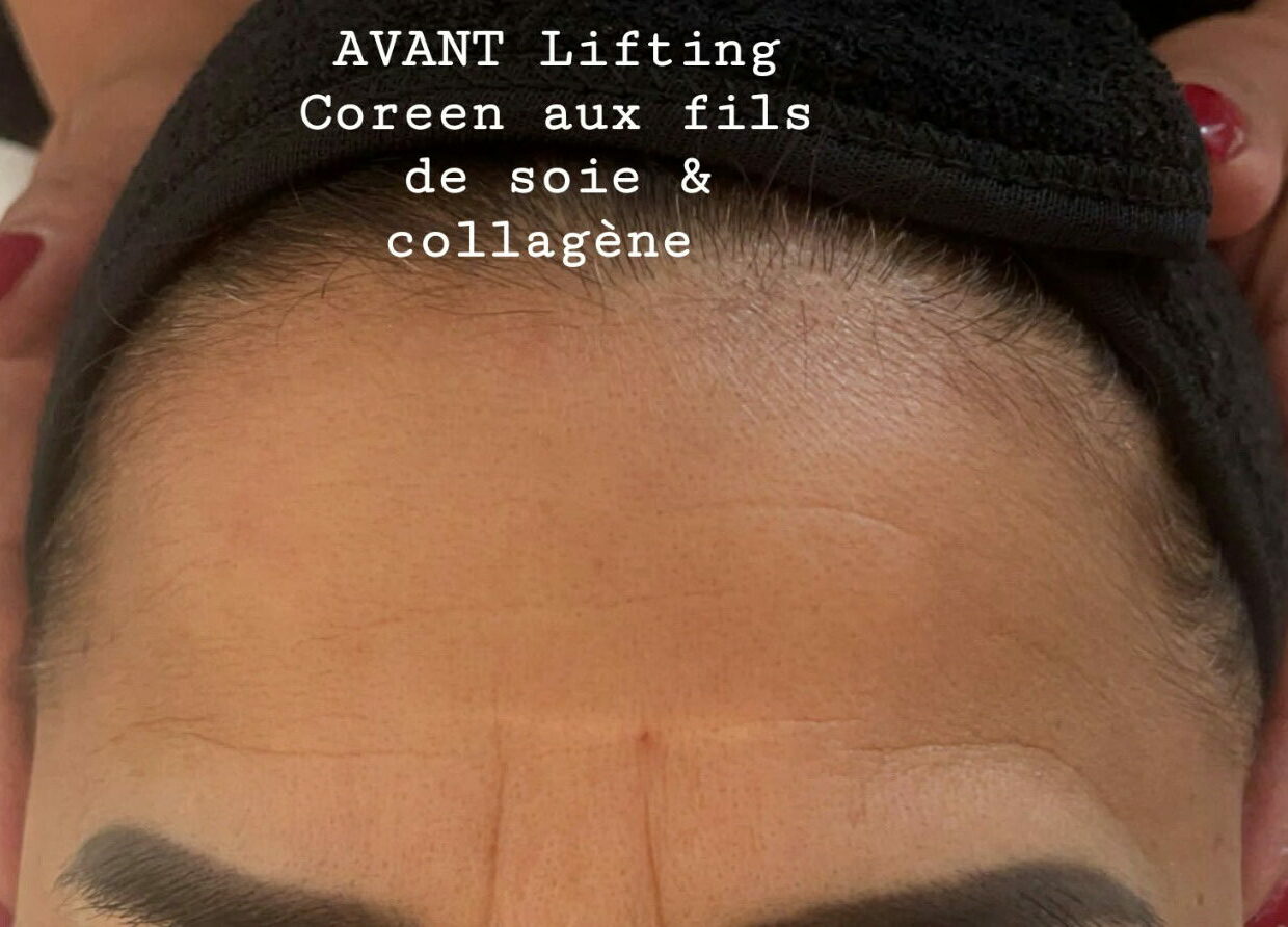 avant lifting coréen aux fils de soie & collagène
