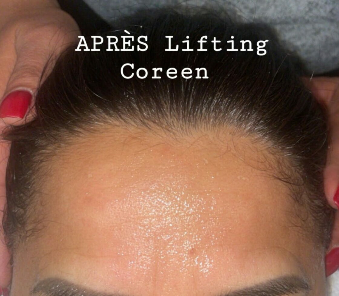 après lifting coréen aux fils de soie & collagène